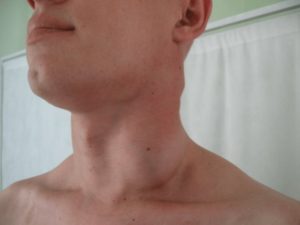 Лимфаденопатия или онкология?