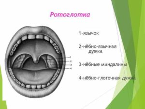Правая миндалина и небный язычок срослись