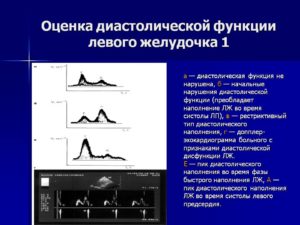МН 1 степени, ТН 1 степени. Диастолическая дисфункция ЛЖ - 1 тип