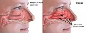 Закладывает нос после лечения гайморита