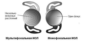Мультифокальный хрусталик