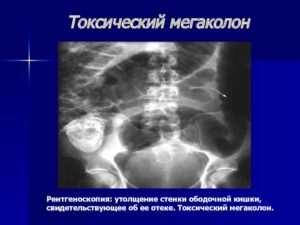 Что это может быть? Утолщение стенки ободочной кишки?