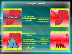Реканализация вен после тромбоза