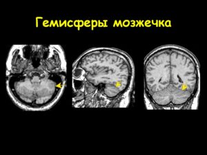 Объемное образование в правой гемисфере мозжечка