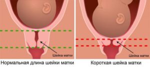 Укороченная шейка матки в 30 недель