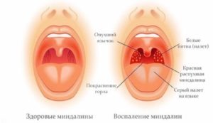 Боли в горле, отек миндалин, красные пятна