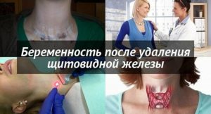 Беременность после резекции щитовидной железы по поводу рака