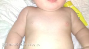 Опух м покраснел сосок у ребенка