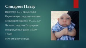 ЭКО, дважды выявлена трисомия 13 хромосомы