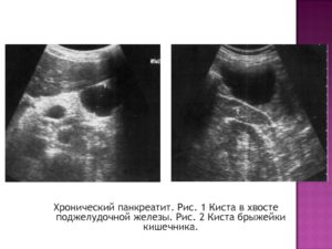 Образование в хвосте поджелудочной железы
