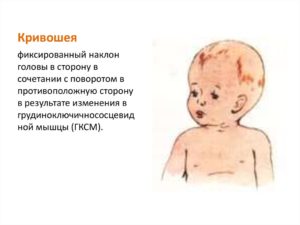 Наклон головы в 3 года