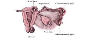 Яичник близко к матке
