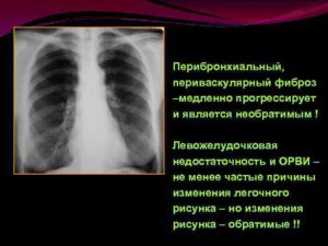 Перибронхиальные изменения