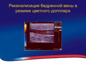 Реканализация вен после тромбоза