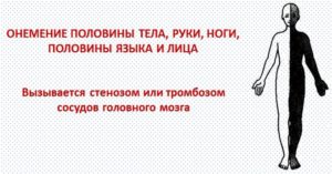 Онемение правой стороны лица и руки