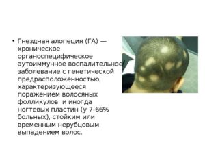 Выпадение волос при аутоиммунных заболеваниях
