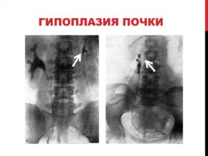 Дистопия и гипоплазия почки плода