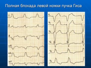 Полная блокада левой ножки пучка гиса
