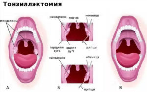 Температура после удаления гланд