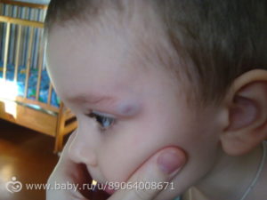 Удар виском у ребенка