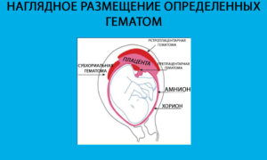 Ретроамниотическая гематома, 15 недель