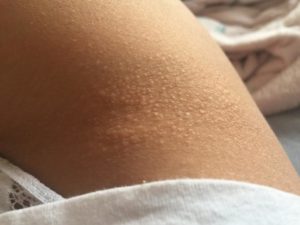Сыпь под грудью, подмышками, в локтевых сгибах и на бедрах
