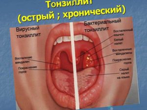 Бугорки на основании языка, хронический тонзиллит