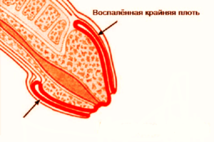 Покраснение головки без симптомов
