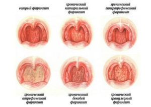 Язвы на задней стенке горла