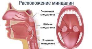 Увеличена миндалина с правой стороны