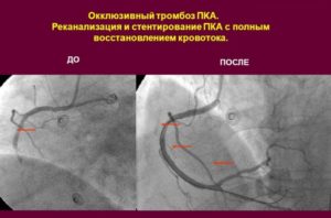 Реканализация вен после тромбоза
