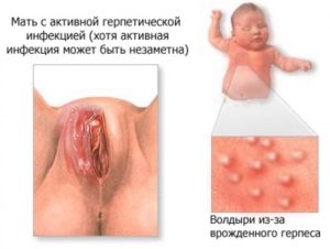 Опухла половая губа слева