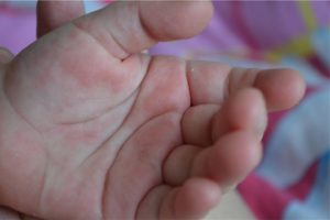 Покраснение на ладошках у ребенка