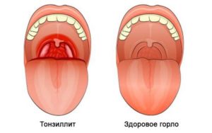 Желтое нёбо, горло, боль, сухость, синие прожилки