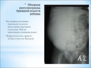 Объемное образование брюшной полости плода