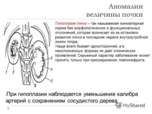 Дистопия и гипоплазия почки плода