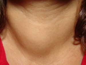 Злокачественный узел на щитовидной железе