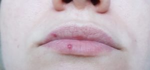 Мелкие красные точки на внутренней стороне губы