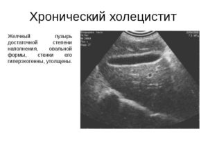Узи желчного пузыря, признаки хронического холецистита