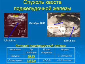 Образование в хвосте поджелудочной железы