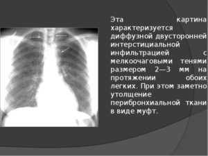 Перибронхиальные изменения