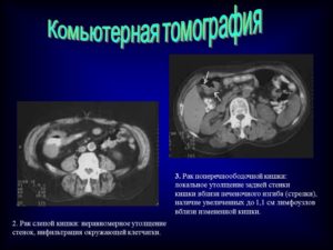 Что это может быть? Утолщение стенки ободочной кишки?