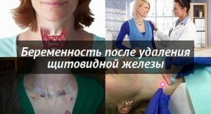 Беременность после резекции щитовидной железы по поводу рака