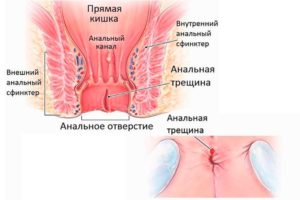Боли в анальном отверстии