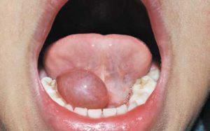 Образования под языком