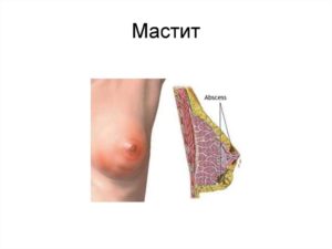 Жжение в соске при ГВ