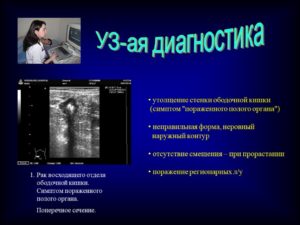 Что это может быть? Утолщение стенки ободочной кишки?