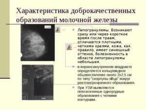 Узловое образование в молочной железе