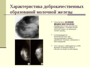 Узловое образование в молочной железе