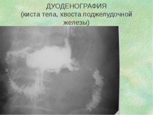 Образование в хвосте поджелудочной железы